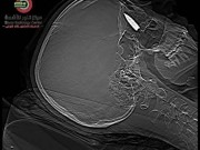 بالصور// معجزة طبية في القاهرة.. إزالة طلق ناري من جمجمة شابة فلسطينية